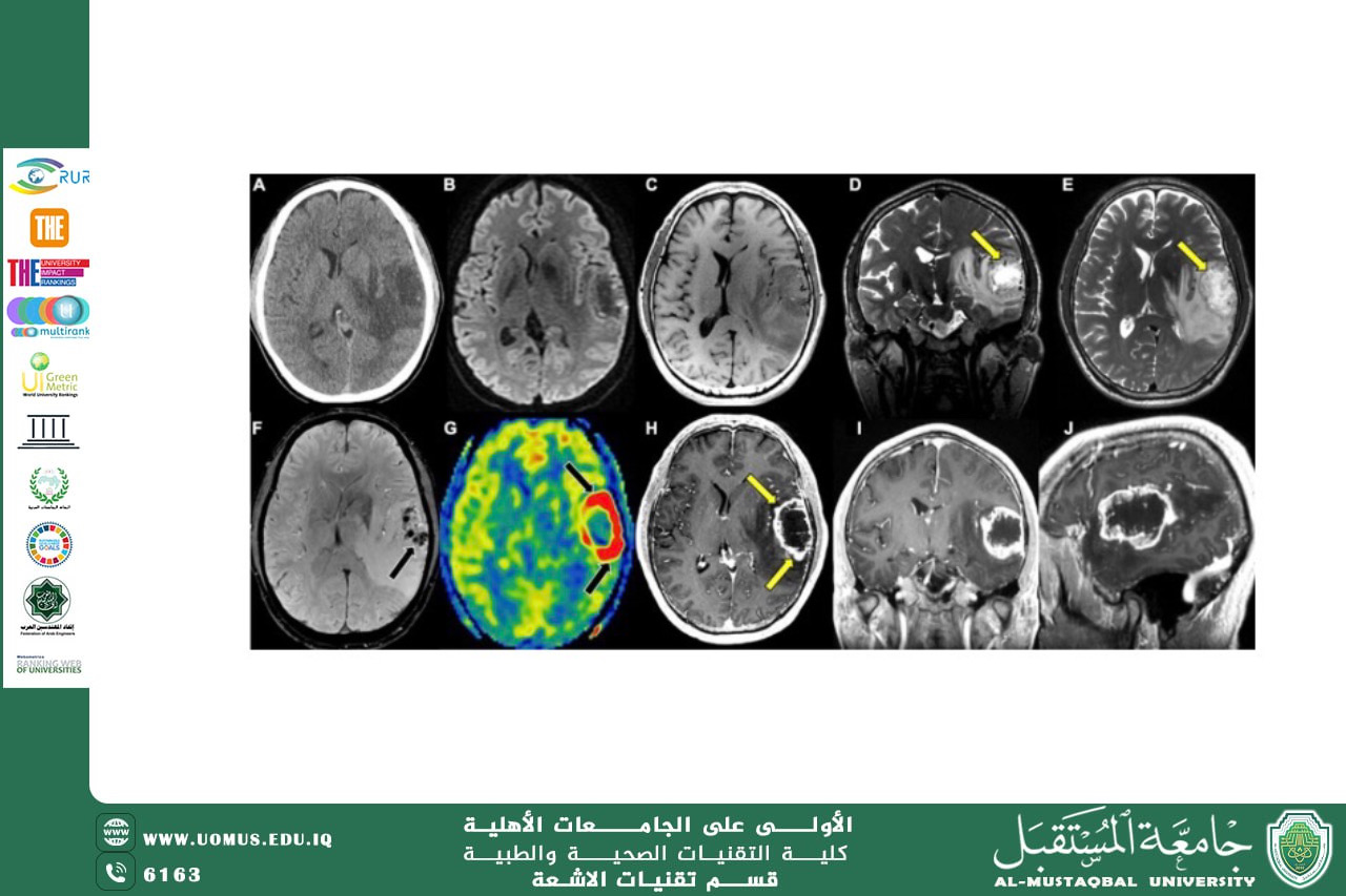 دور الرنين المغناطيسي باستخدام(Multiparametric ) MRI (T1, T2, FLAIR, DWI, Perfusion) لتشخيص لأورام  الدماغ