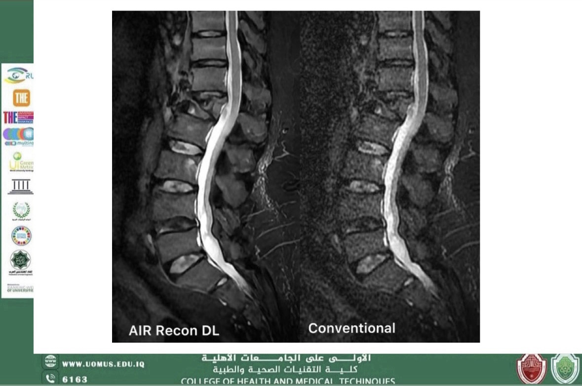 أحدث تطورات الذكاء الاصطناعي في التصوير الطبي بالرنين المغناطيسي (MRI): نحو تشخيص أسرع وأكثر دقة
