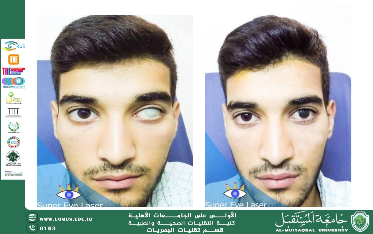 مقالة علمية لرئيس قسم تقنيات البصريات أ.م.د منذر سمين شكر بعنوان "تلوين العين المصابة بتقنية تاتو"