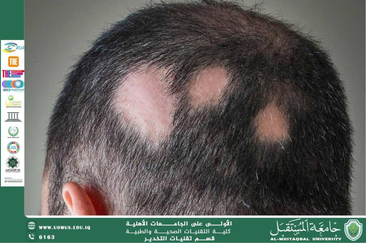 Alopecia Areata