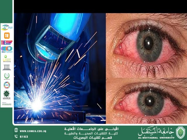 مقالة لرئيس قسم تقنيات البصريات ا.م.د منذر سمين شكر حول تأثير البيئه على العيون