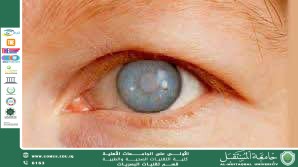 مقاله علمية للست حوراء صادق هاتف بعنوان الزَرق (الجلوكوما) وأثره على صحة العين