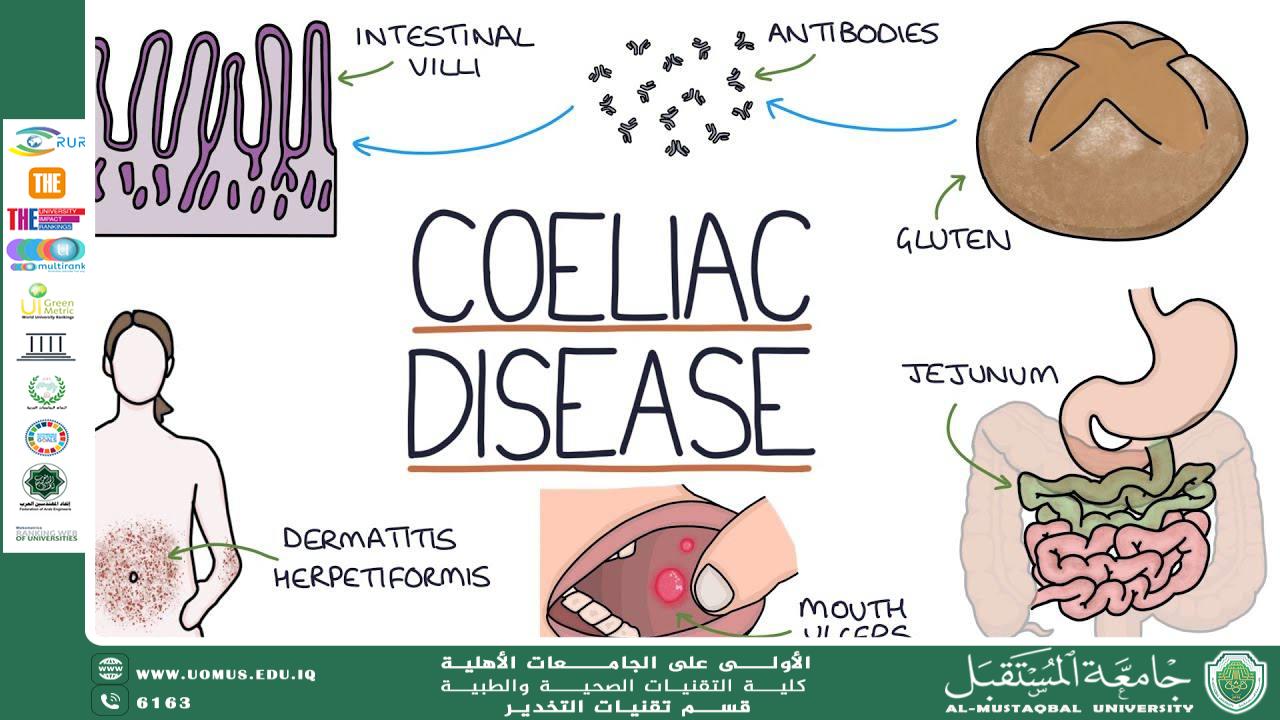 Scientific Article about Screening for Celiac Disease: Guidelines for Early Detection