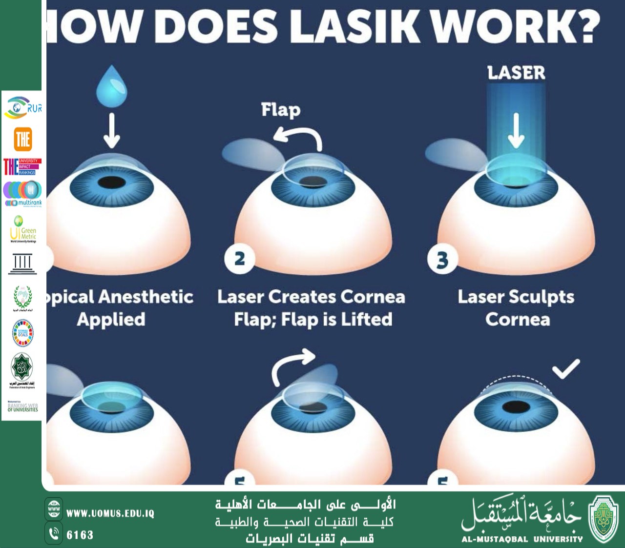 مقاله علمية للتدريسي حمزه نادر بعنوان الليزر في طب العيون لتصحيح الاخطاء الانكسارية