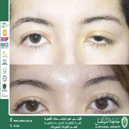 مقالة علمية للتدريسي غيث علي محمود بعنوان: هطول الجفن