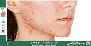 Hormonal Fluctuations and Skin Inflammation