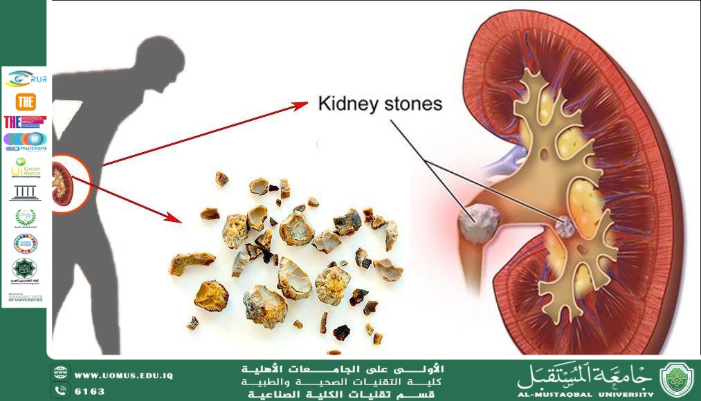 Asst. Lecturer Zainab Ali Mohsen The Impact of Soft Drinks on Kidney Health and Their Role in Causing Kidney Failure
