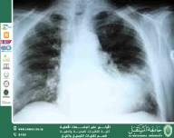 مقالة علمية للست شهد نورس عباس بعنوان وجود السوائل على الرئة (Pulmonary Edema)