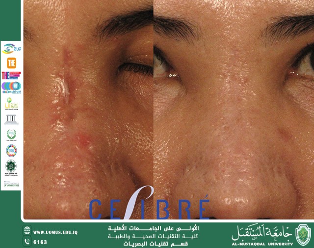 مقاله علمية للتدريسية تمارا نهاد عباس بعنوان(تأثير الليزر في علاج الندبات الجلدية)