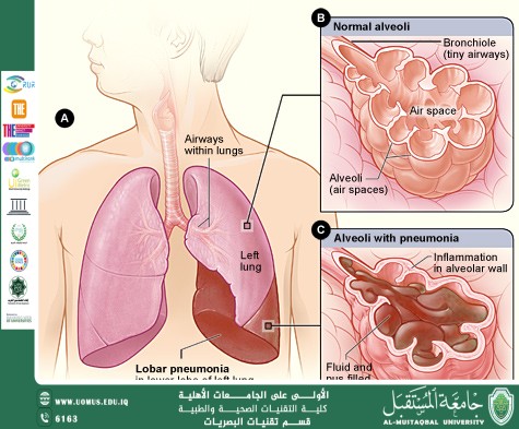 مقالة علمية للتدريسية تمارا نهاد عباس حميد بعنوان(ذات الرئة)