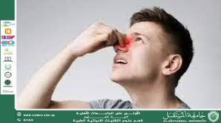 A scientific article (by Heba Salah Hadi) entitled "Nosebleeds"