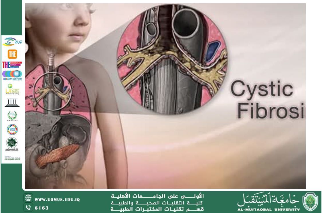 مقالة علمية بعنوان : التليف الكيسي (Cystic Fibrosis)