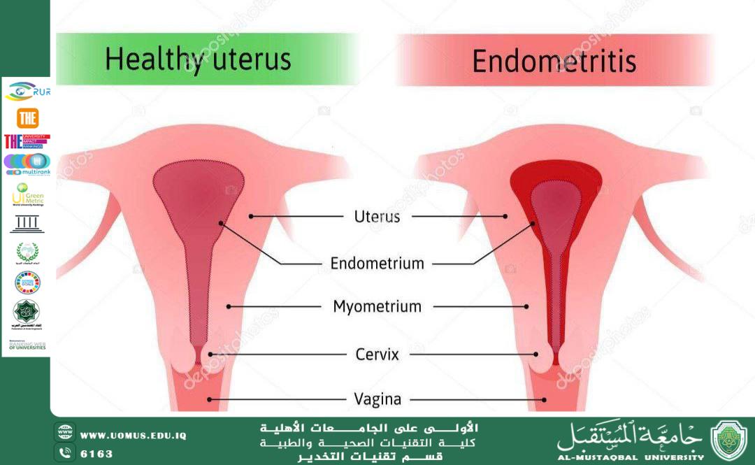 Management of Uterine Inflammation Before Progression to Hysterectomy