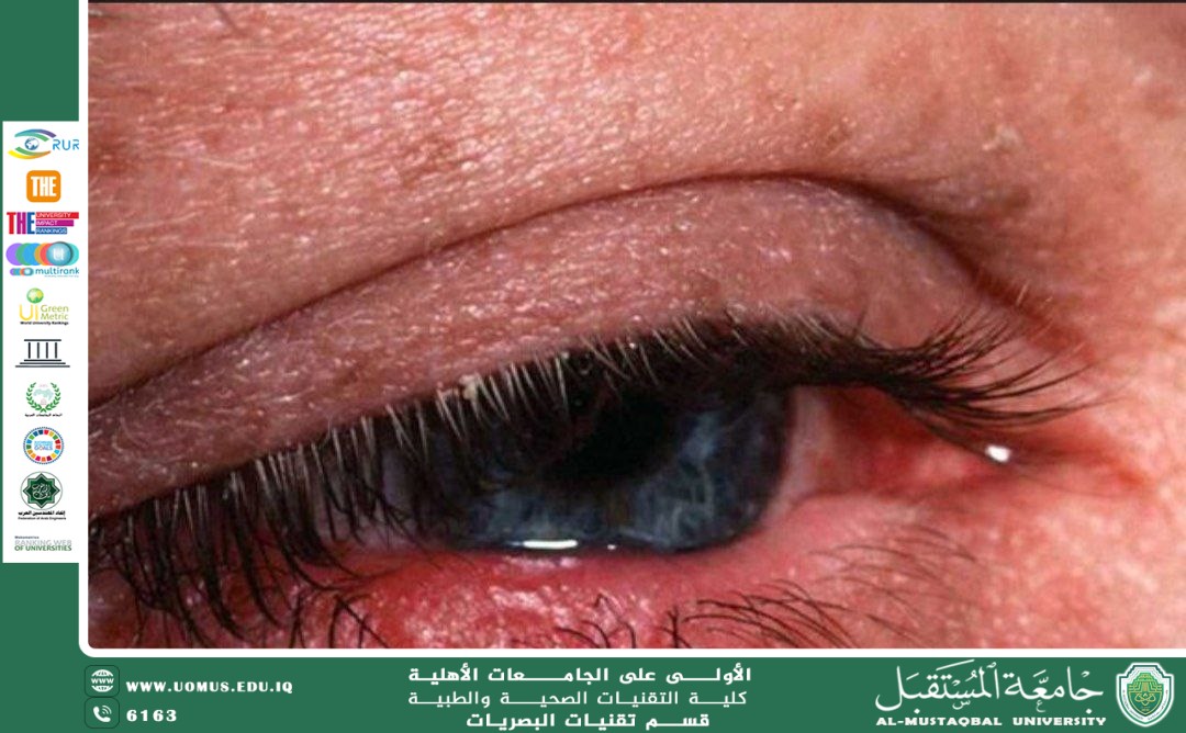 مقالة علمية للست زينب احمد عباس بعنوان"جفاف العين"