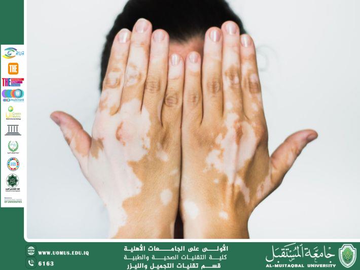 مقالة للمعيده هدى رافد عبد الخالق بعنوان جينات الميلانين وتأثيرها على أمراض الجلد