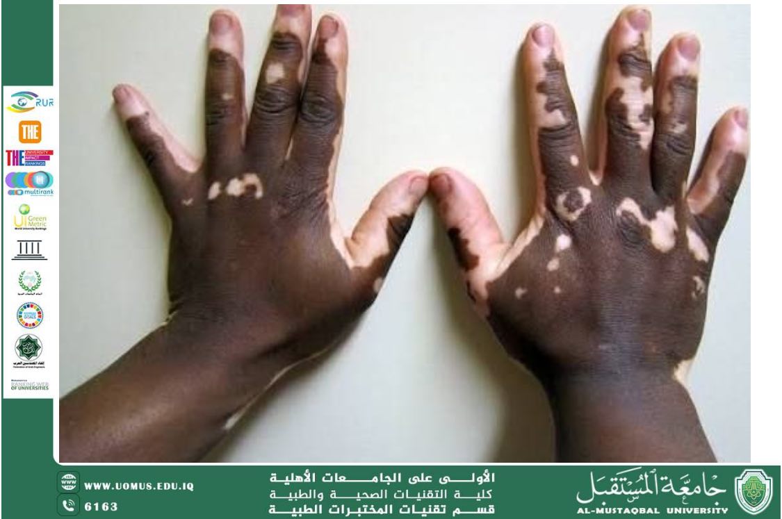 مقالة علمية للتدريسية دنيا محمد مبدر بعنوان : البهاق