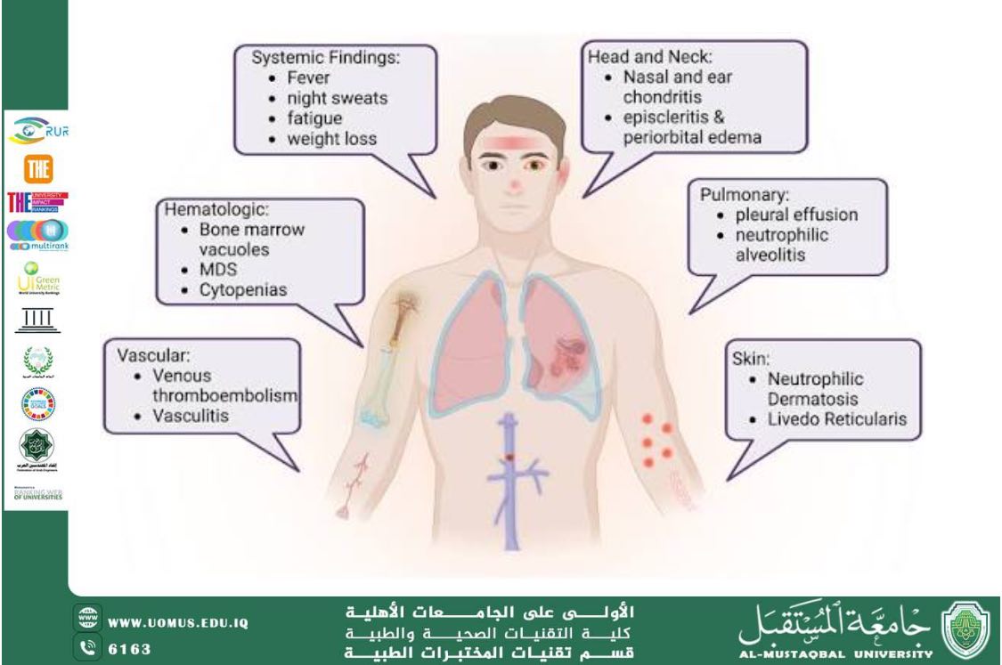 مقالة علمية للدكتورة ورود علي هذال بعنوان : متلازمة VEXAS (VEXAS Syndrome)