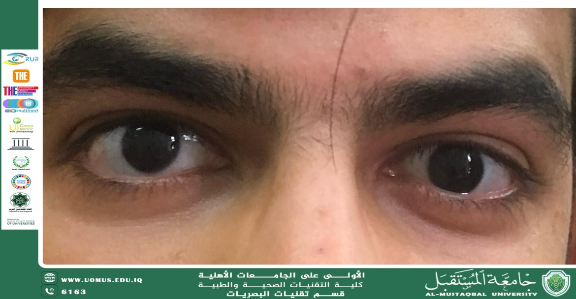 مقالة علمية لرئيس قسم تقنيات البصريات ا.م.د منذر سمين شكر حول تدلي الجفون  المكتسبة عند البالغين