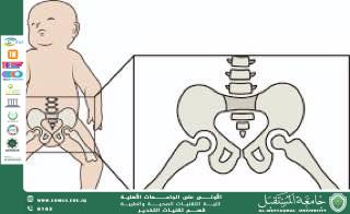 Developmental Dysplasia of the Hip (DDH) — Formerly Known as Congenital Dislocation of the Hip