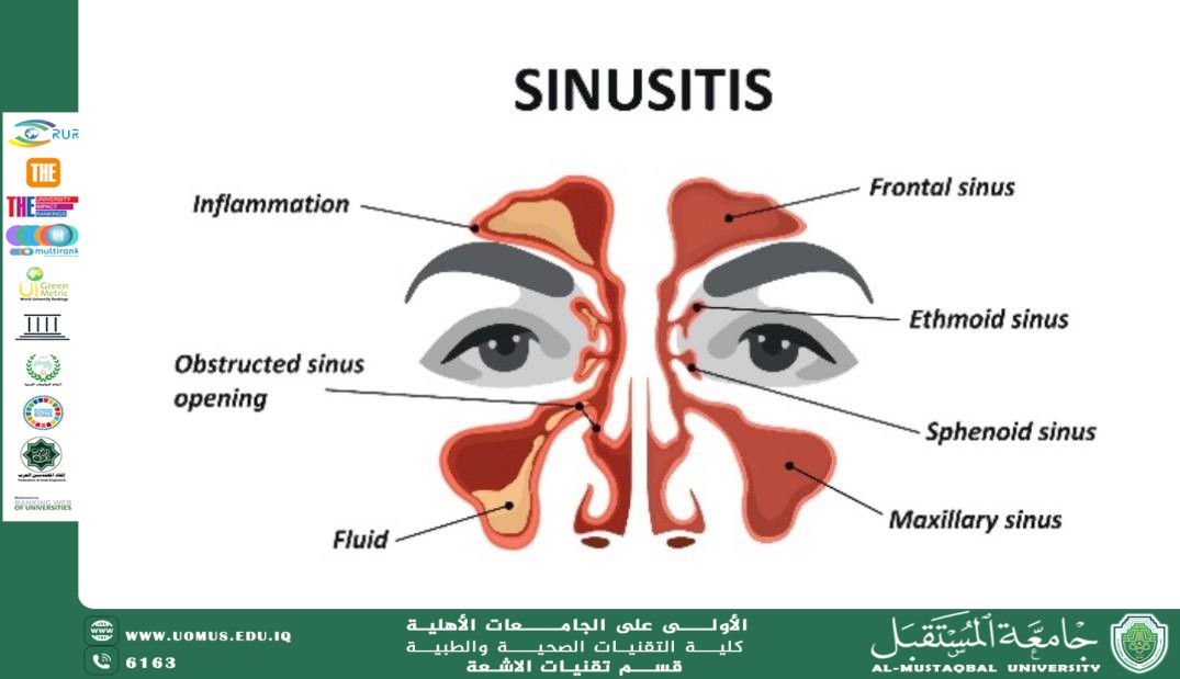 التهاب الجيوب الانفية