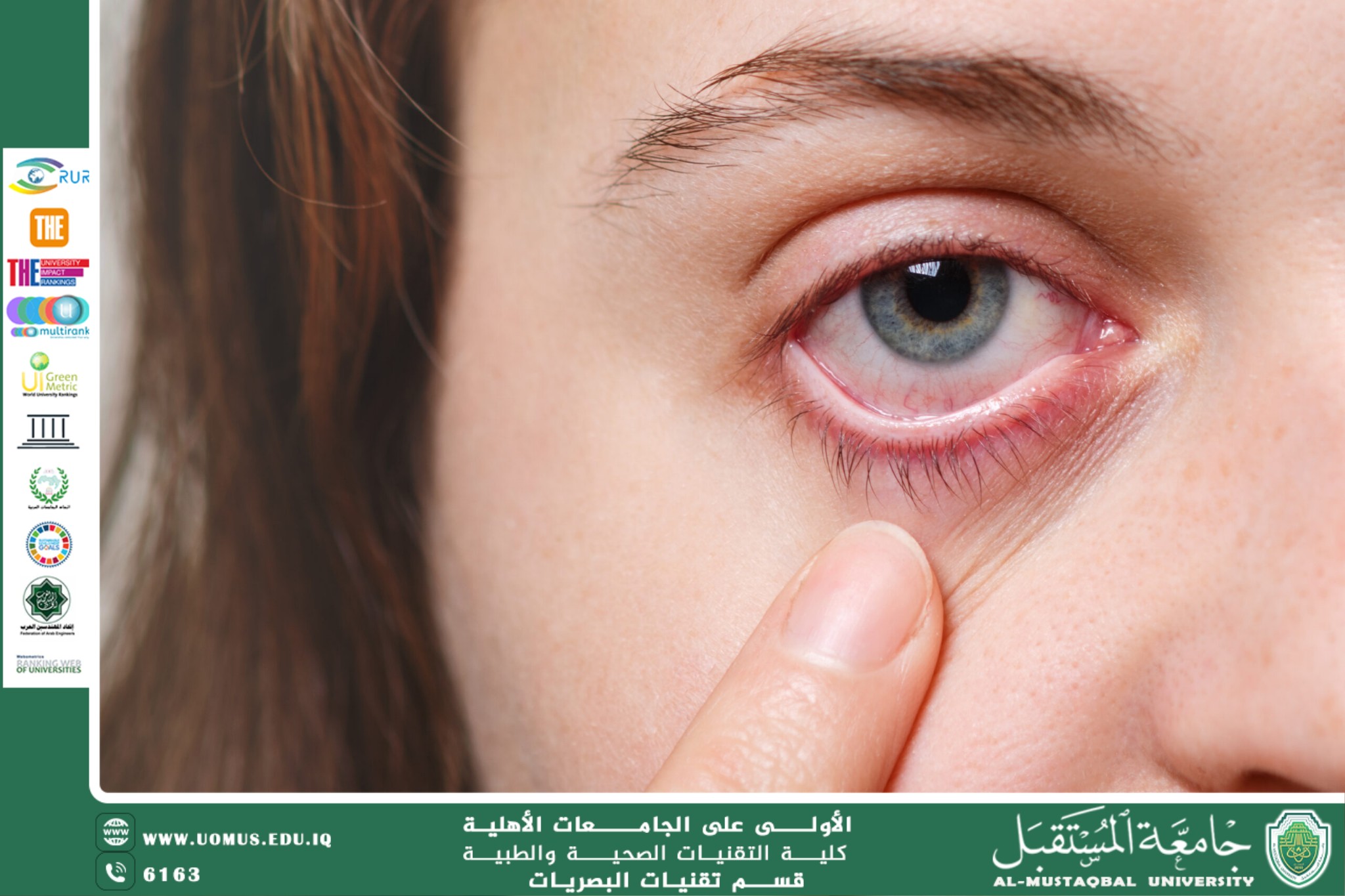 مقالة علمية للست زهراء عباس علي  بعنوان "جفاف العين (Dry Eyes)"