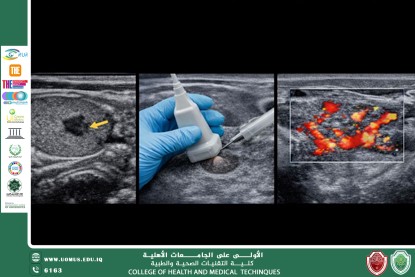 دور السونار  في الكشف عن امراض الغدة الدرقية