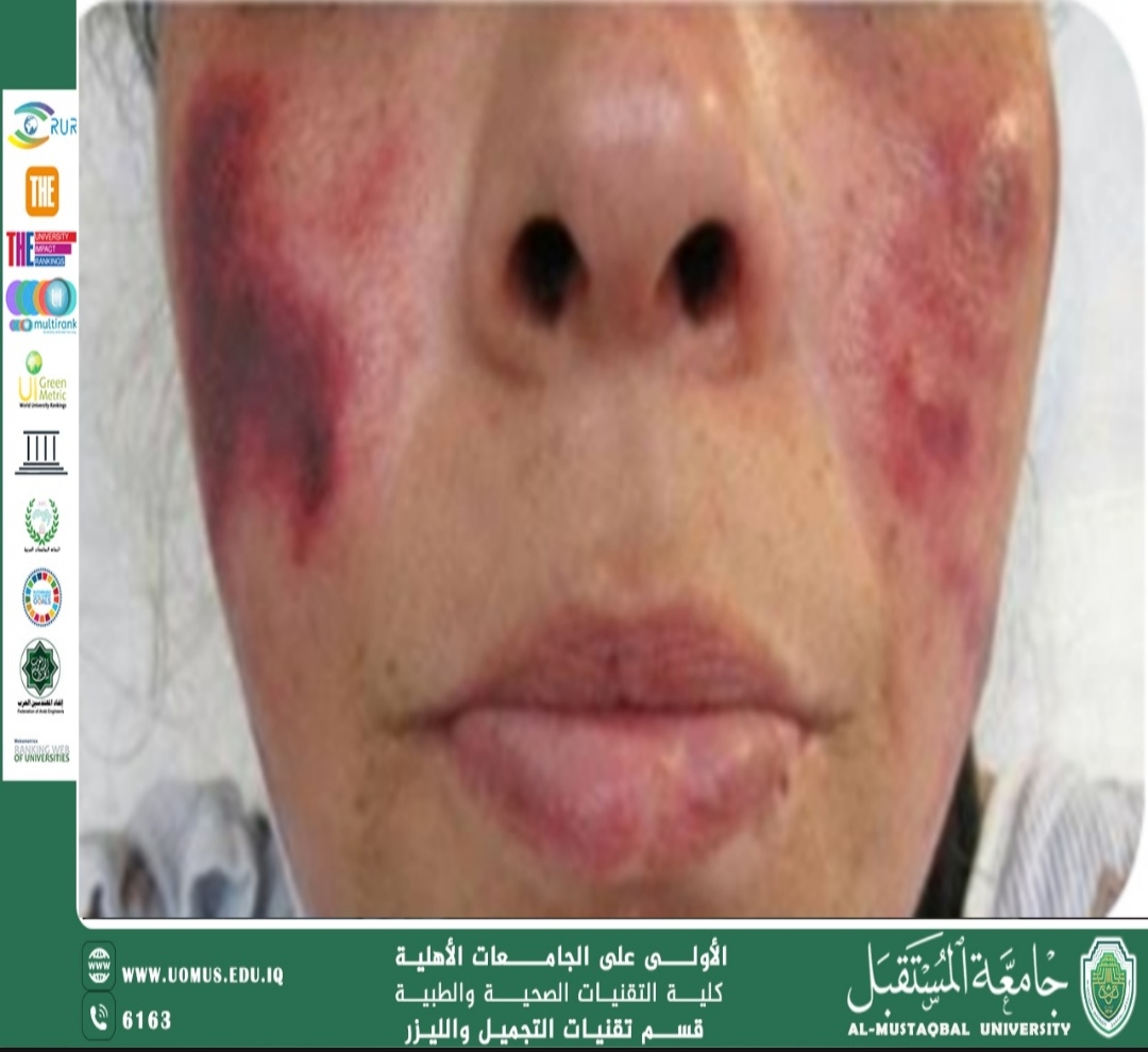 Scientific Article by Ms. Shahad Nawras Abbas Title: The Effect of Drugs on the Skin