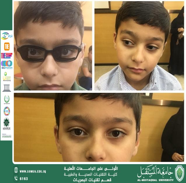 مقالة علمية لرئيس قسم تقنيات البصريات  أ.م.د منذر سمين شكر بعنوان"استخدام  نظارة التضبيب في علاج العوق الفيزيائي لرقبة المريض "