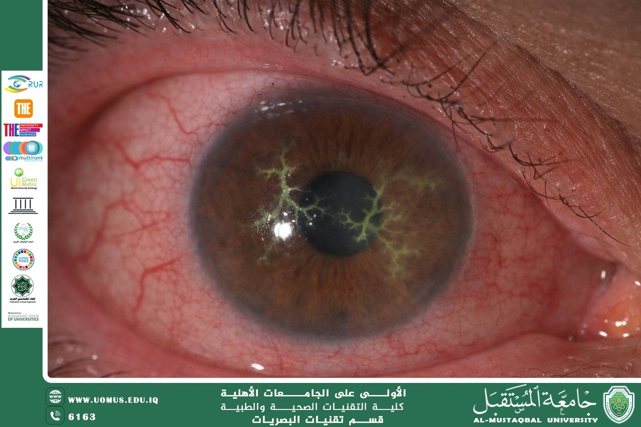 مقاله علمية للتدريسيه ريهام صفاء نجم بعنوان التهاب القرنية الهربسي (Herpetic Keratitis)