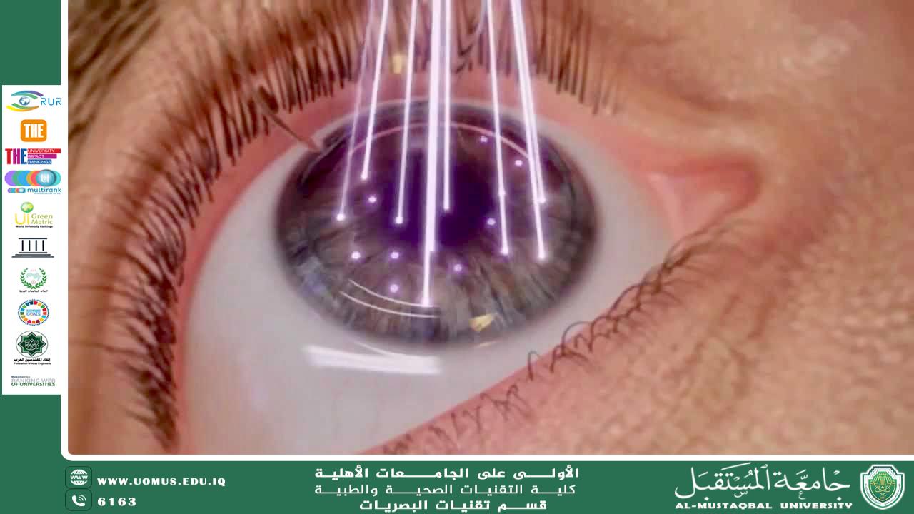 مقالة علمية للست اسلام فاضل موسى بعنوان استخدام الليزر في علاج مشاكل القرنية