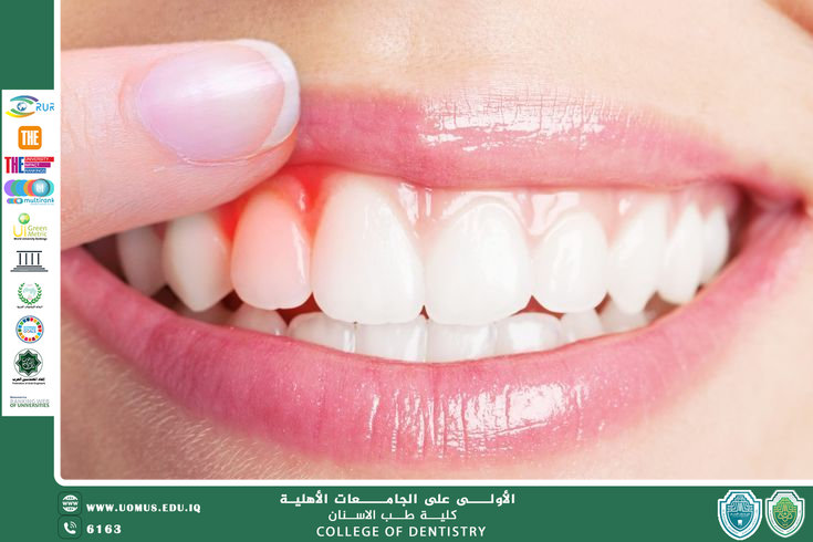 العلاقة بين صحة اللثة وثبات الأسنان