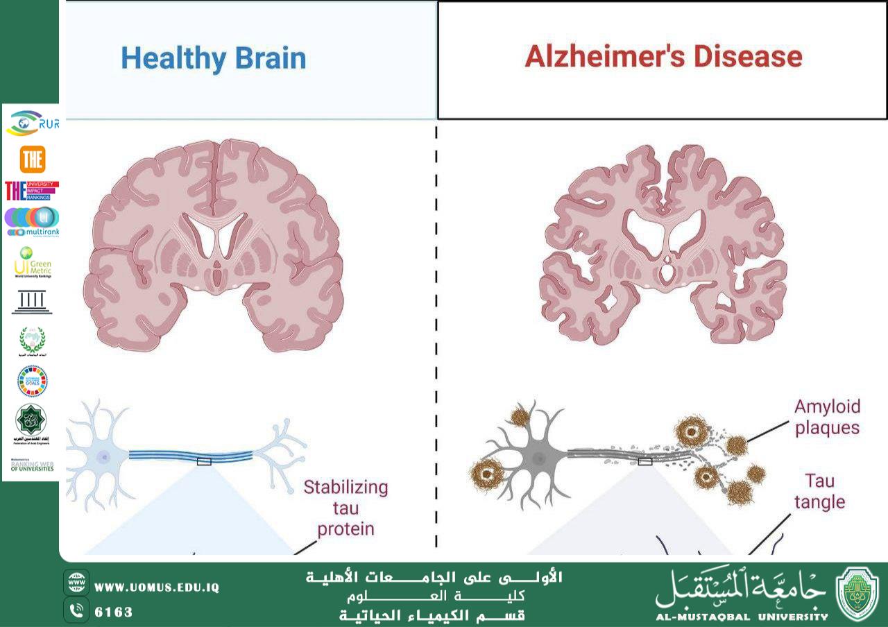 مقالة علمية بعنوان مرض ألزهايمر: الآليات الحيوكيميائية والعصبية المرضية من قبل التدريسي : م.م. عباس حمزة خضير