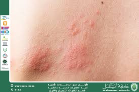 Nuclear Radiation and Its Effects on the Skin